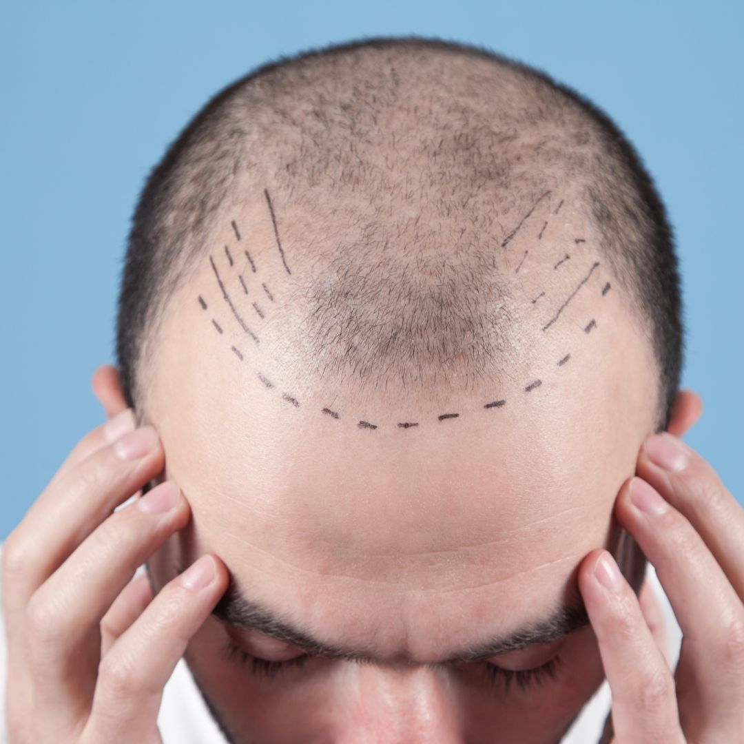 Hair Transplant in Turkey and Gym: What You Should Know
