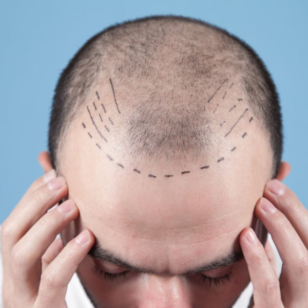 Hair Transplant in Turkey and Gym: What You Should Know
