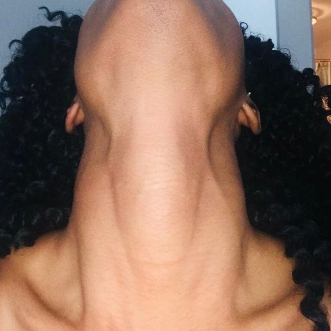 how to get rid of neck fat