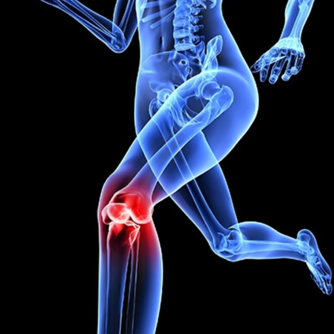 patellofemoral pain syndrome