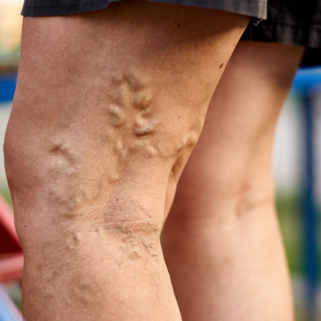 varicose vein exercises